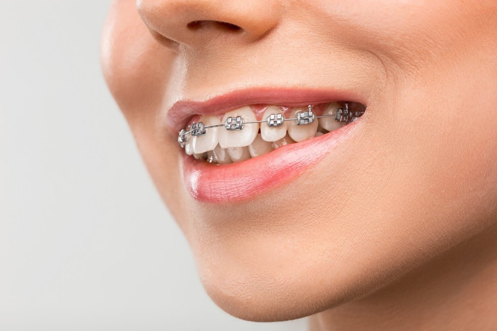 What Are Dental Braces for and What Are the 4 Types of&nbsp;Braces?